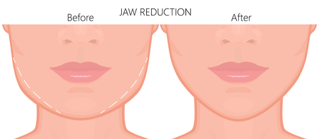 What Under-Eye Fillers Can Do