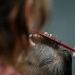 Who Is a Good Candidate for PRP Therapy for Hair Loss? Expert Insights and Recommendations