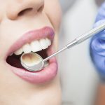 Teeth Whitening for Sensitive Teeth: Affordable Solutions That Work