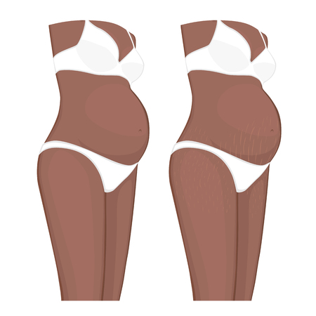 Popular Cellulite Treatment Options