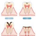 How to Choose the Best Cosmetic Dentist for Affordable Veneers