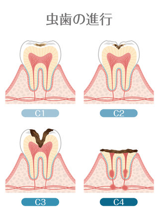 How to Choose the Best Cosmetic Dentist for Affordable Veneers