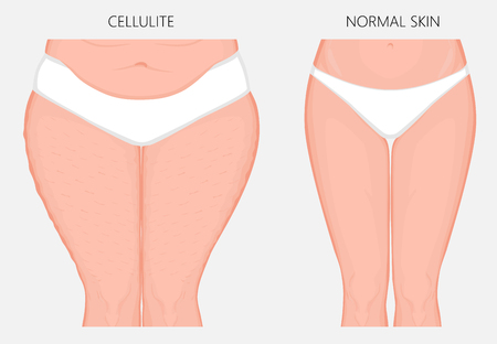 What Is Emsculpt?