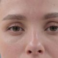 The Role of Lymphatic Drainage in Reducing Under-Eye Puffiness